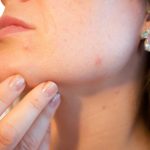 hormonal acne