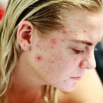 Fungal Acne