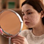 hormonal acne