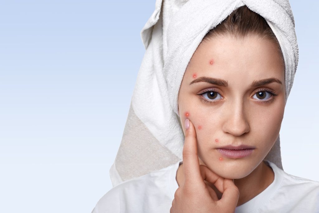 hormonal acne