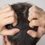 scalp acne