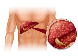 10 Signs Your Liver Needs Detoxing
